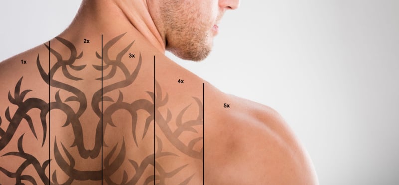 Tattoo Removal Clinics
